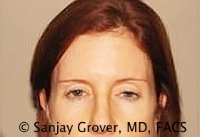 Blepharoplasty Before and After 17 | Sanjay Grover MD FACS