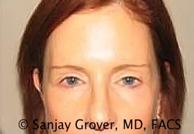 Blepharoplasty Before and After | Sanjay Grover MD FACS