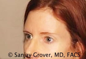 Blepharoplasty Before and After 14 | Sanjay Grover MD FACS