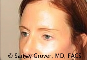 Blepharoplasty Before and After 14 | Sanjay Grover MD FACS