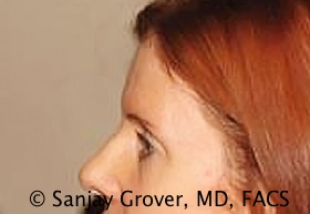 Blepharoplasty Before and After 14 | Sanjay Grover MD FACS