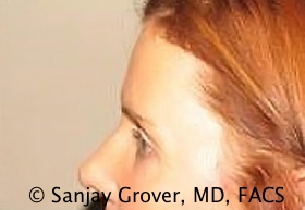 Blepharoplasty Before and After 14 | Sanjay Grover MD FACS