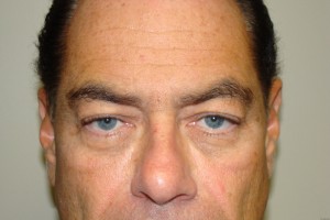 Blepharoplasty Before and After 30 | Sanjay Grover MD FACS