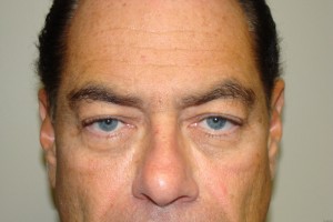 Blepharoplasty Before and After 03 | Sanjay Grover MD FACS