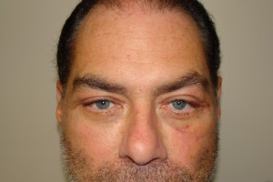 Blepharoplasty Before and After | Grover Aesthetics