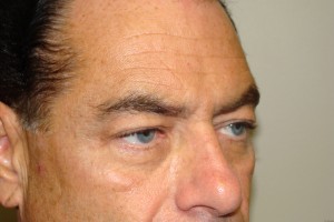 Blepharoplasty Before and After 15 | Sanjay Grover MD FACS