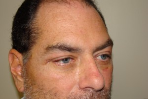 Blepharoplasty Before and After 15 | Sanjay Grover MD FACS