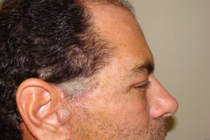 Blepharoplasty Before and After 15 | Grover Aesthetics