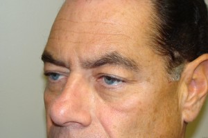 Blepharoplasty Before and After 15 | Grover Aesthetics