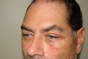Blepharoplasty Before and After 15 | Grover Aesthetics