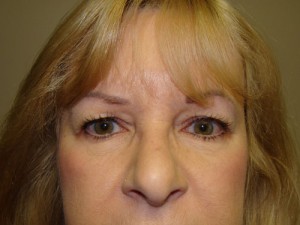 Blepharoplasty Before and After | Grover Aesthetics