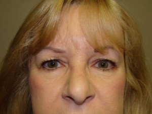 Blepharoplasty Before and After 33 | Sanjay Grover MD FACS