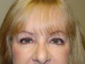 Blepharoplasty Before and After 16 | Sanjay Grover MD FACS