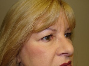 Blepharoplasty Before and After 16 | Sanjay Grover MD FACS