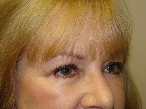 Blepharoplasty Before and After 16 | Sanjay Grover MD FACS