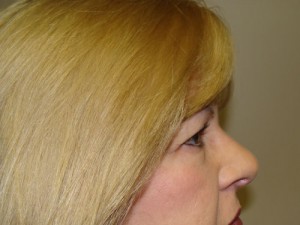 Blepharoplasty Before and After 16 | Grover Aesthetics