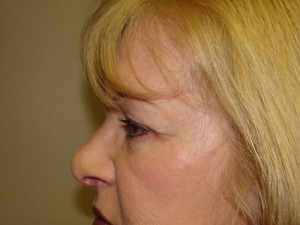 Blepharoplasty Before and After 16 | Sanjay Grover MD FACS