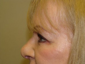 Blepharoplasty Before and After 16 | Grover Aesthetics