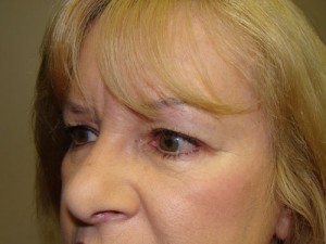 Blepharoplasty Before and After 16 | Grover Aesthetics