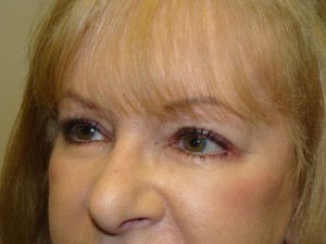 Blepharoplasty Before and After 16 | Sanjay Grover MD FACS