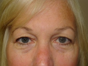 Blepharoplasty Before and After 07 | Sanjay Grover MD FACS