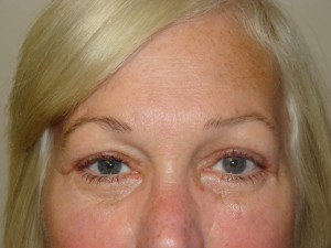 Blepharoplasty Before and After | Grover Aesthetics