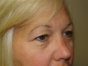 Blepharoplasty Before and After 17 | Grover Aesthetics