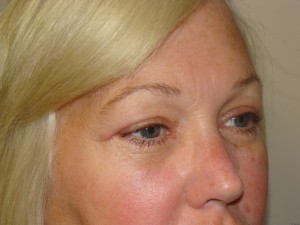 Blepharoplasty Before and After 17 | Grover Aesthetics