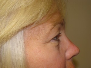 Blepharoplasty Before and After 17 | Grover Aesthetics