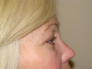 Blepharoplasty Before and After 17 | Grover Aesthetics