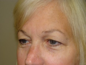 Blepharoplasty Before and After 17 | Grover Aesthetics