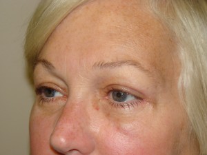 Blepharoplasty Before and After 17 | Sanjay Grover MD FACS