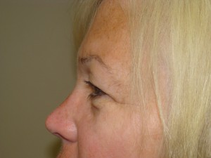 Blepharoplasty Before and After 17 | Grover Aesthetics