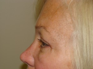 Blepharoplasty Before and After 17 | Sanjay Grover MD FACS