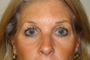Blepharoplasty Before and After | Grover Aesthetics