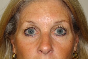 Blepharoplasty Before and After 01 | Sanjay Grover MD FACS