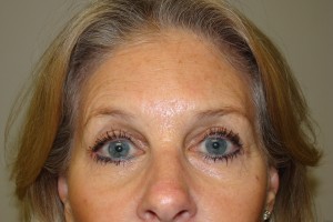 Blepharoplasty Before and After | Grover Aesthetics