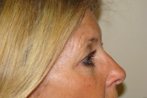 Blepharoplasty Before and After 18 | Sanjay Grover MD FACS