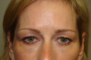 Blepharoplasty Before and After 15 | Sanjay Grover MD FACS