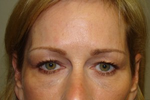 Blepharoplasty Before and After | Grover Aesthetics