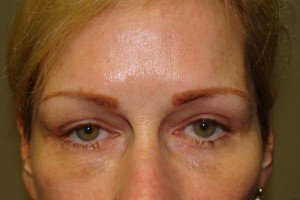 Blepharoplasty Before and After | Grover Aesthetics