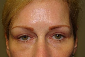 Blepharoplasty Before and After | Sanjay Grover MD FACS