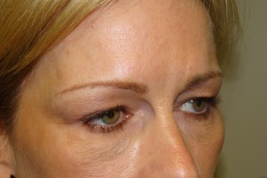 Blepharoplasty Before and After 19 | Sanjay Grover MD FACS