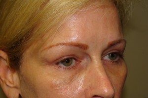 Blepharoplasty Before and After 19 | Sanjay Grover MD FACS