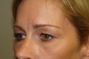 Blepharoplasty Before and After 19 | Grover Aesthetics