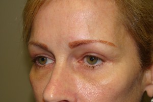 Blepharoplasty Before and After 19 | Sanjay Grover MD FACS