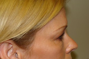 Blepharoplasty Before and After 19 | Grover Aesthetics
