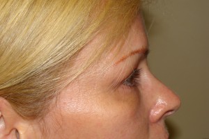 Blepharoplasty Before and After 19 | Grover Aesthetics