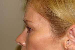 Blepharoplasty Before and After 19 | Grover Aesthetics