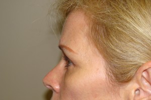 Blepharoplasty Before and After 19 | Grover Aesthetics
